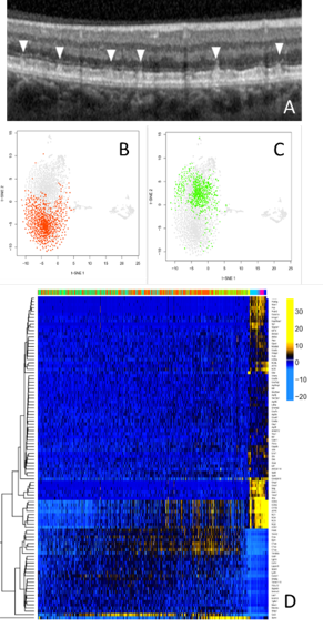 Figure 1 Pseudodrusen studies. (A) Subretinaol deposits in patients on a retinal scan. (B,C) The results of a single immune cell sequencing showing clear differences between 'good' (red) and 'bad' active immune cells. (D) Heatmap showing which genes in normal and diseased retinal immune cells vary (yellow).
