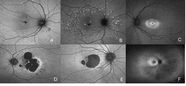 Figure 1 Autofluorescence images of different types of PRPH2 associated disease – (A) Pattern dystrophy, (B) Multifocal pattern dystrophy, (C) Cone dystrophy, (D) Macular dystrophy with atrophy, (E) Central areoalar chorioretinal dystrophy and (F) Retinitis pigmentosa